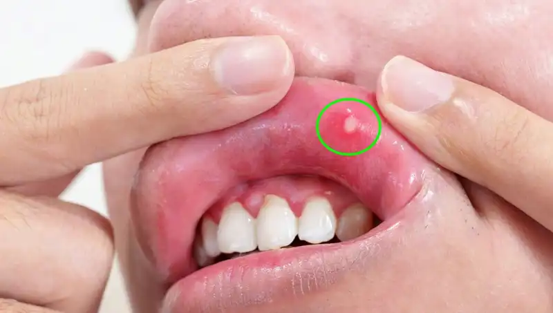 B Vitamini Eksikliği Belirtileri: Sağlığınızı Tehdit Ediyor Olabilir