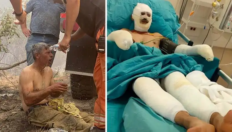 Orman İşçisinin Yanıklara Dayanılmaz Çığlığı: Tedavisi Devam Ediyor